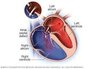 Image result for what are the symptoms of having a hole in the heart?