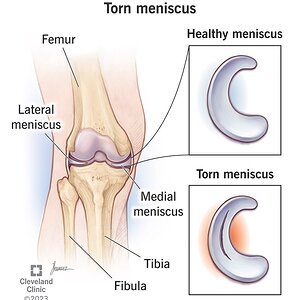 torn-meniscus.jpg